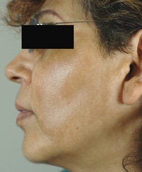 Melasma Treatment before 120088