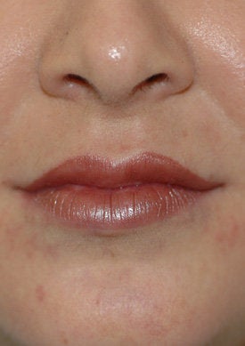 Restylane lip injections after 93353
