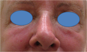 Juvederm Filler for lower eyelid hollows after 77458
