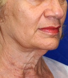 Neck Lift before 531123