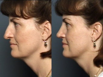 Nose Surgery 338473