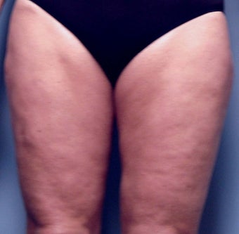 Slim Lipo before 137501