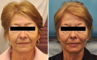 Restylane and Perlane used to volumize the entire face. before 216359