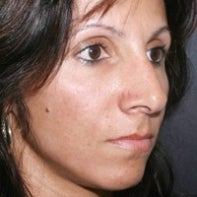 Revision Rhinoplasty after 442998