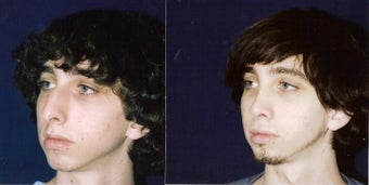 Rhinoplasty and Septoplasty before 241678