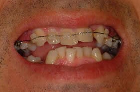 Complete Smile Makeover before 96896