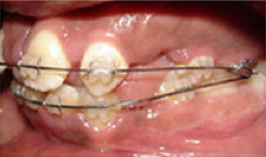 Braces and Extraction 349088