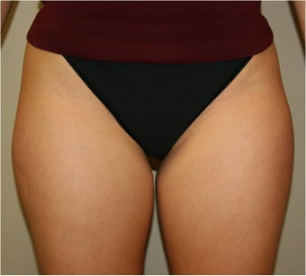 SmartLipo SaddleBags and Medial Thighs (mild) before 109408