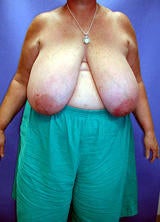 Breast Reduction Surgery before 122992