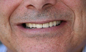 Full Porcelain Crowns (no metal) after 109209