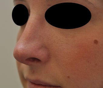 Non-surgical rhinoplasty before 182427