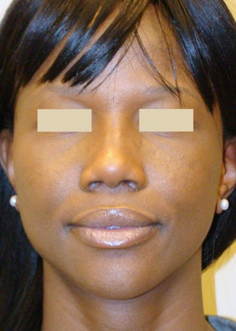 African American Rhinoplasty after 104225