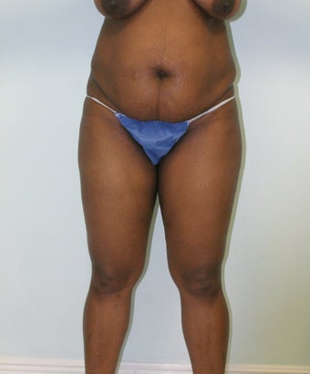 Brazilian butt lift before 365596