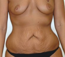 Mommy Makeover- Abdominoplasty and Breast Augmentation before 253102
