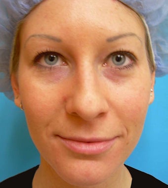 Under-Eye Filler Treatment after 567450