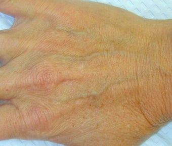 Sclerotherapy treatment for hand before 371748