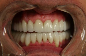 smile makeover with porcelain veneers after 625416