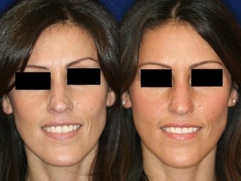 Non-Surgical Rhinoplasty before 229775