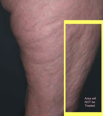 Cellulite treatment before 113276