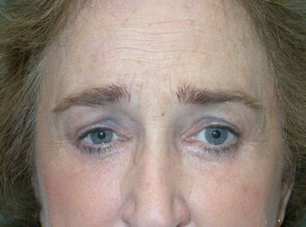 Upper and Lower Lid Blepharoplasty and Cheeklift after 148579