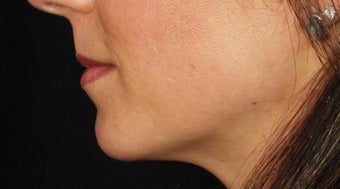 Lip Augmentation before 399231