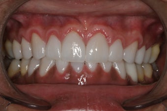 Porcelain Veneers after 213075