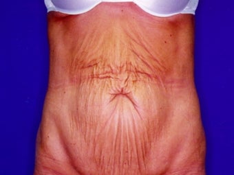 Tummy tuck after massive weight loss before 91226
