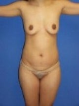 Breast Augmentation, Mommy Makeover before 465789