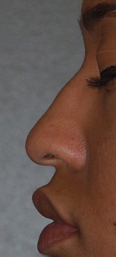 Rhinoplasty before 271667