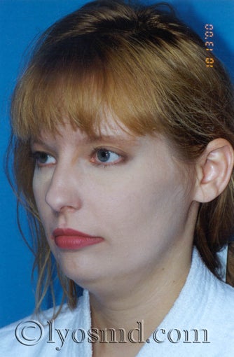 Endoscopic Browlift, Liposuction of the Neck and Jawline - Facelift before 224866