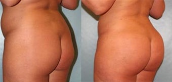 Brazilian Butt Lift before 192133