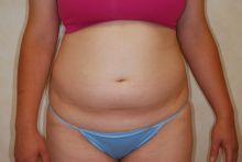 Liposuction of the abdomen before 267324