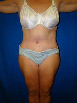 Tummy Tuck Surgery (abdominoplasty) and Liposuction after 119470
