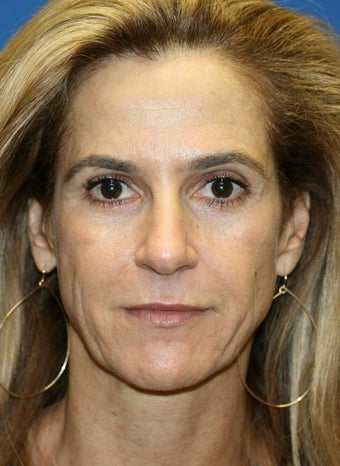 Short Incision Face Lift and periorbital fat transfer before 223301