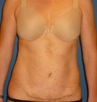 Mini-Abdominoplasty with VASER liposuction 384685