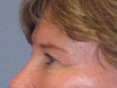 Brow Lift 541493