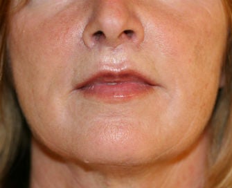 Lip Lift after 380418
