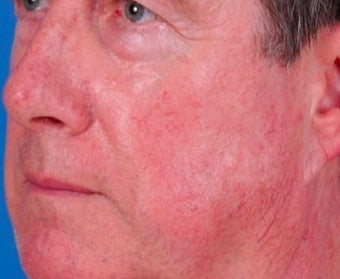 Vbeam laser rosacea treatment before 374582