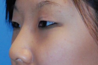 Asian blepharoplasty before 199356