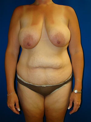 Breast Lift, Breast Reduction Surgery before 149381