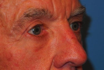Extended lower lid blepharoplasty 480035
