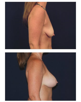 Breast Augmentation with Lift before 287017