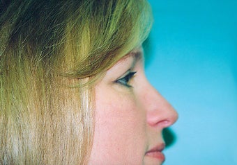 Eyelid Surgery (Belpharoplasty) after 265352