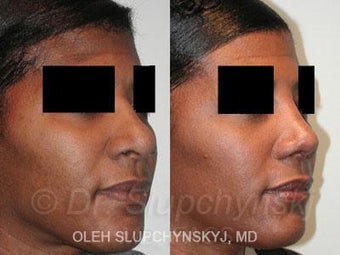 African American Rhinoplasty 374017