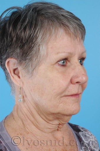 Limited Incision Facelift, Upper and Lower Blepharoplasty before 255909