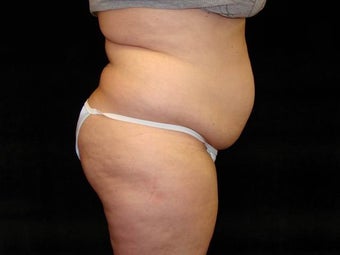 Liposuction of Abdomen, Waist, Flanks and Dorsal Roll before 203474