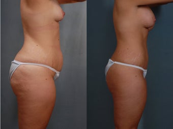 Mommy Makeover, Tummy Tuck, Liposuction, Breast Augmentation before 313068