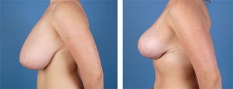 Breast Reduction 355748
