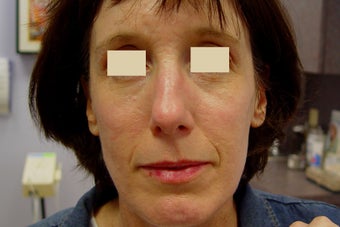 Fraxel Restore Treatment of Acne Scarring after 152212