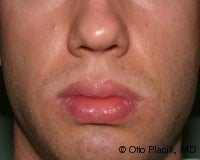 Lip Reduction before 565920